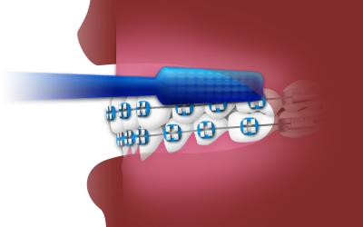 Brushing with braces